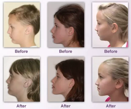 beforeafter